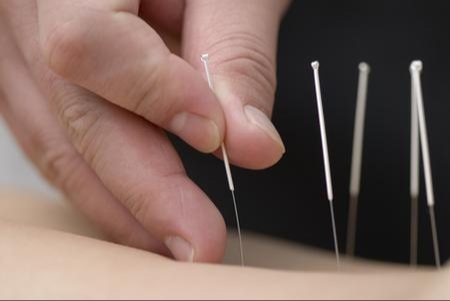close up of acupuncture